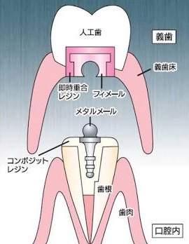 入れ歯（アタッチメント入れ歯）