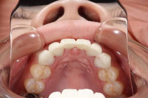 小児歯科矯正について