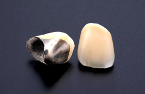 プラスチック前装冠（保険適用）